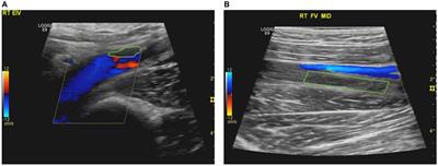 Case report: Deep vein thrombosis as the sole clinical feature of Behcet’s syndrome